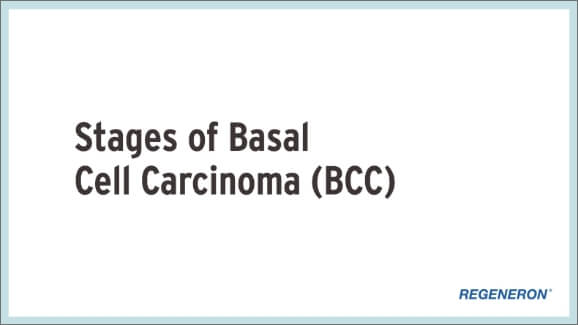 Animated stages of basal cell carcinoma (BCC) Visualization follows the progression of basal cell carcinoma (BCC) from localized BCC, through locally advanced and metastatic stages. Tumors spread from localized areas to underlying tissues, muscles and nerves, causing damage to heathy tissue until they eventually spread beyond their original location to other parts of the body.